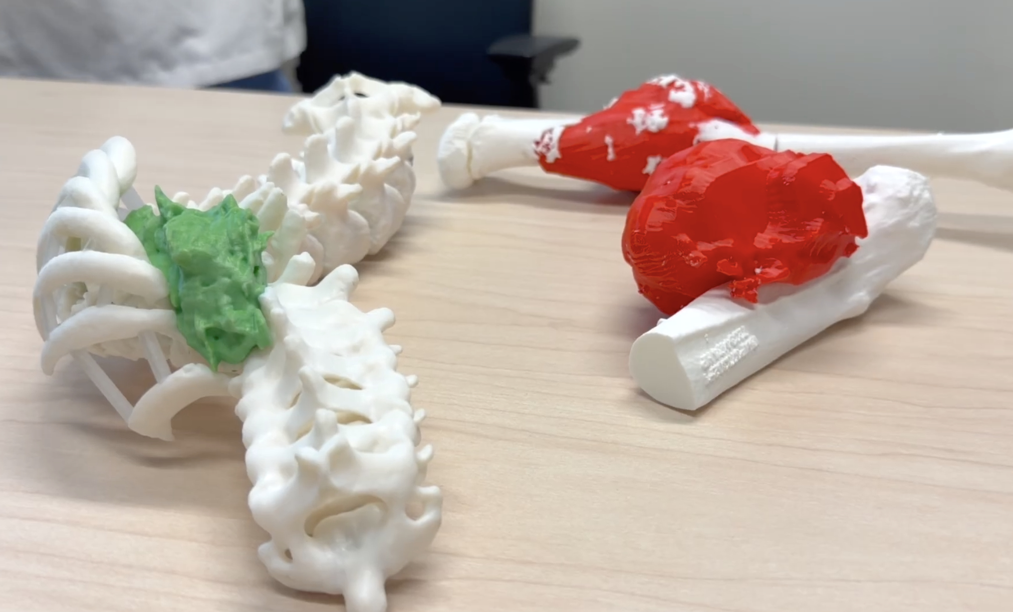 IU Health’s 3D printing studio helps surgeons prepare and educate patients